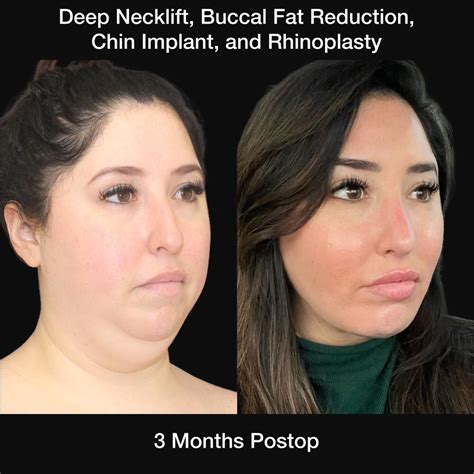 buccal fat removal gone wrong